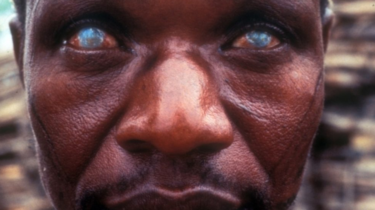 Onchocerciasis – Protecting Eyesight and Public Health in Africa | Photo credit: Africa Health Organisation